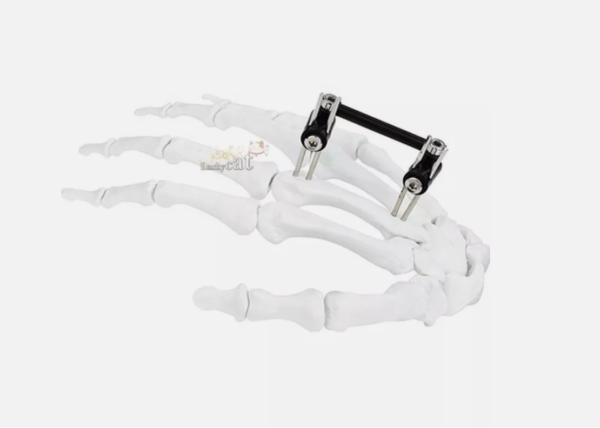 Mini Fragment External Fixator Orthopedic Implant Ilizarov External Fixation - Image 3