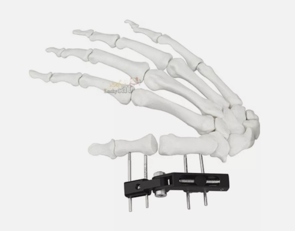 Mini Fragment External Fixator Orthopedic Implant Ilizarov External Fixation
